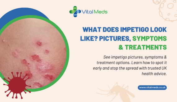 What Does Impetigo Look Like? Pictures, Symptoms & Treatments